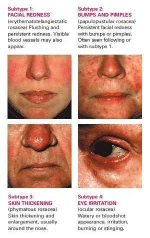 melanotan rosacea Rosacea: Symptoms and Treatment main image 0