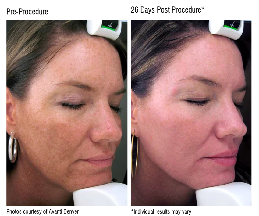 melasma image