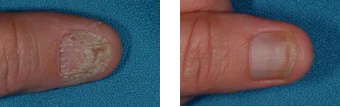 nail fungus image