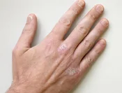 nail_psoriasis image