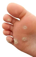 plantar_wart image