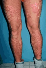 psoriasis_legs_before image
