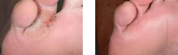 wart foot image
