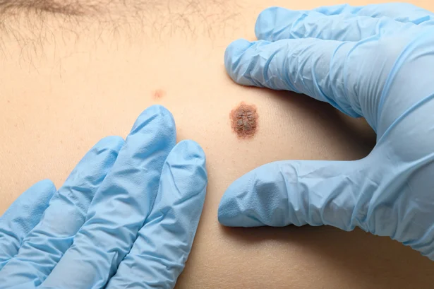 Skin Cancer image
