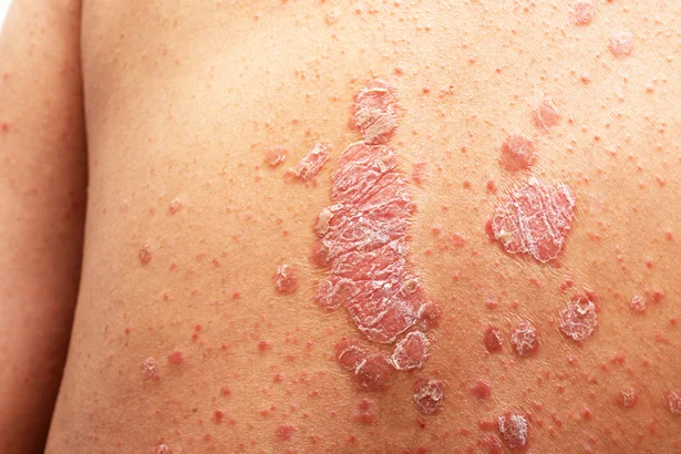 Psoriasis image