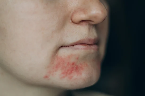 atopic dermatitis image