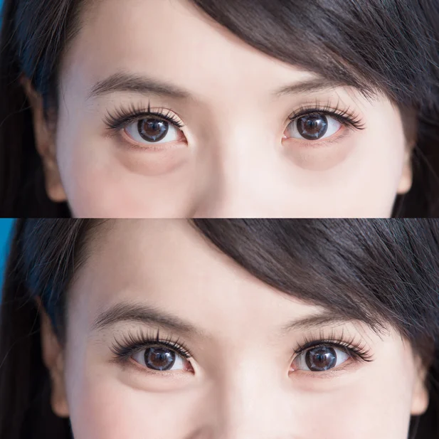 Dark Circles Under the Eyes image