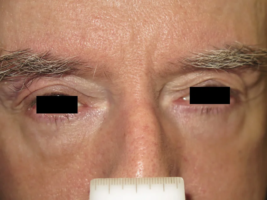 Eyelids image
