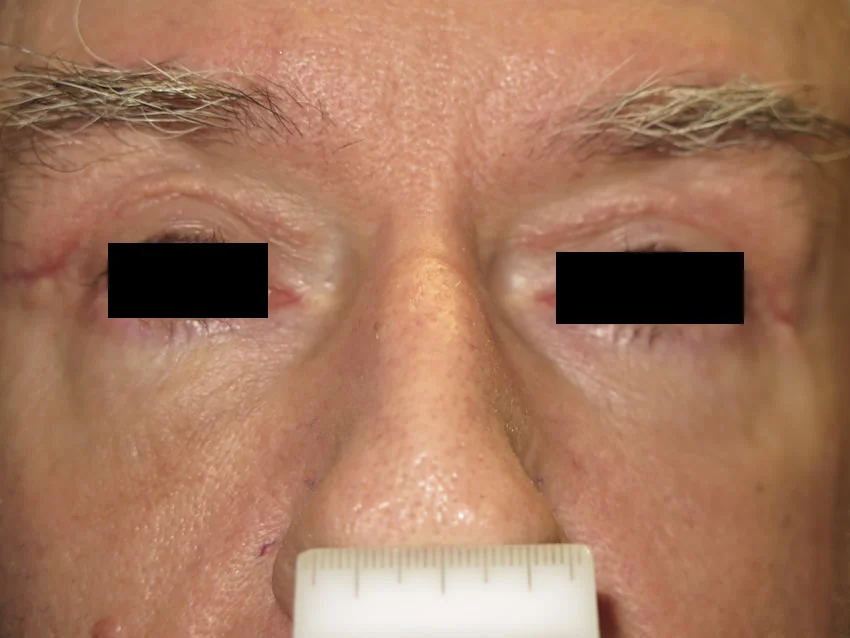 Eyelids image