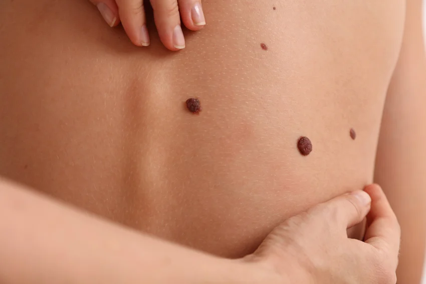 moles