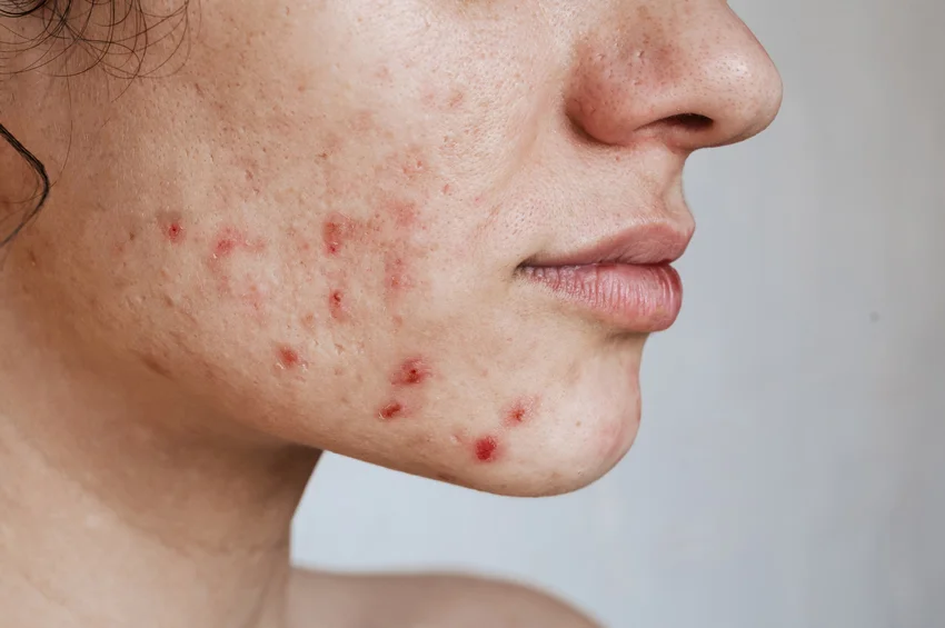 acne image