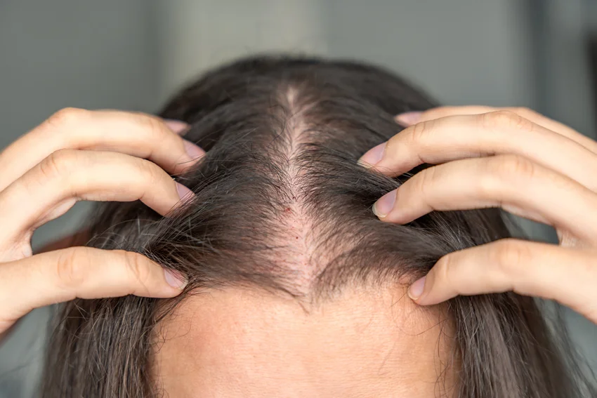 Female: Hair Loss image