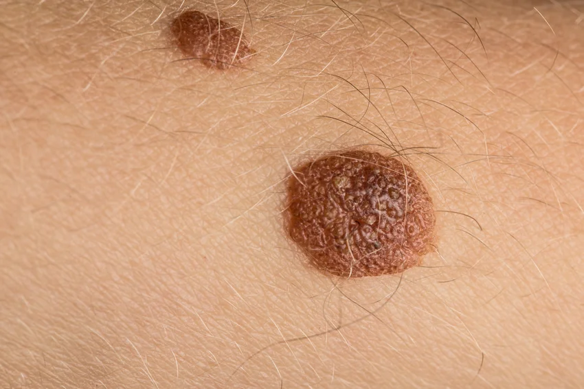 skin cancer image