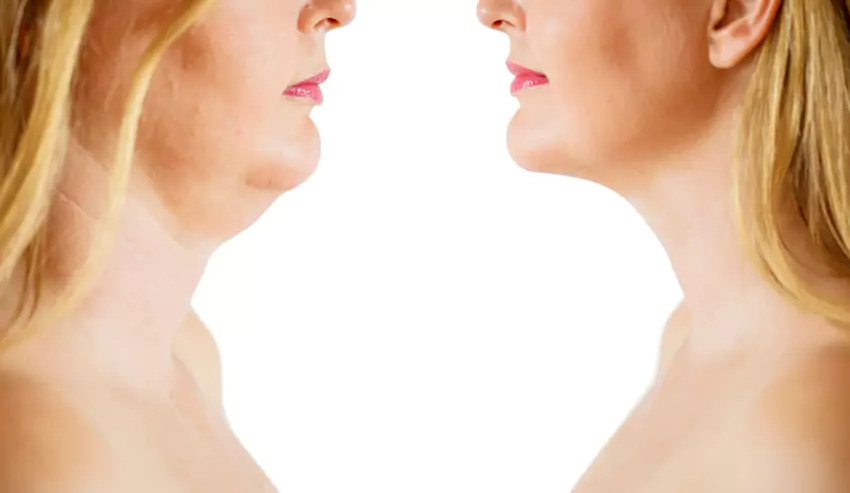 Kybella Injection image