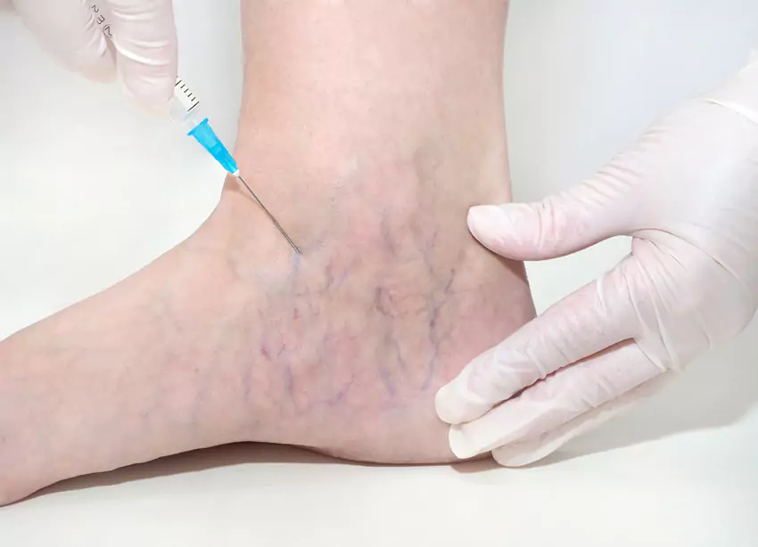 Sclerotherapy image