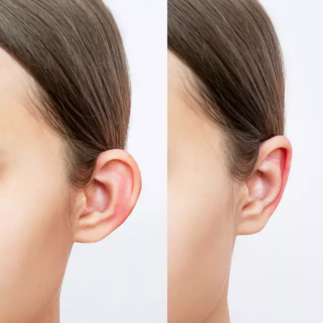 Earlobe Repair image