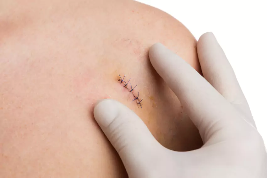 Tattoo Removal Options image