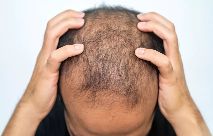 Hair Loss: Male image